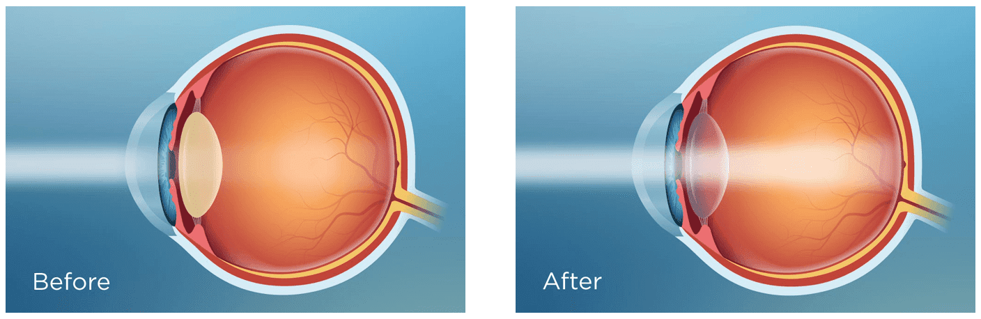 How To Preserve Your Rejuvenated Vision After Cataract Surgery 