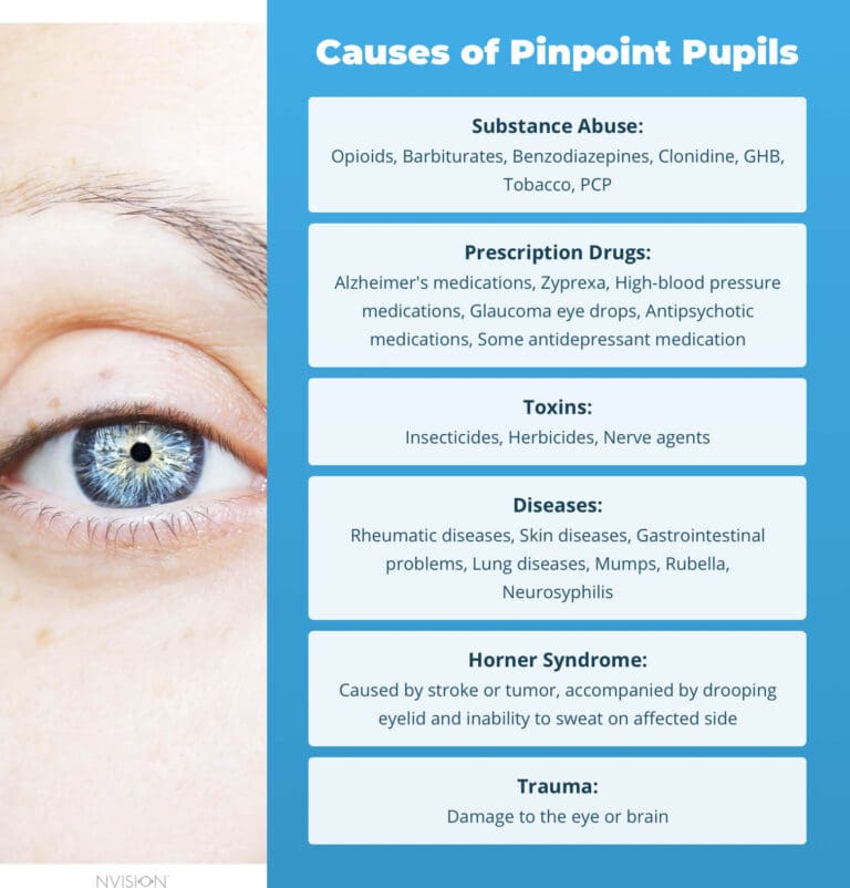 migraine symptoms pupil constriction