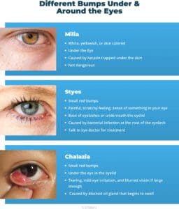 Bumps Under the Eyes: Types & How to Treat Them – NVISION