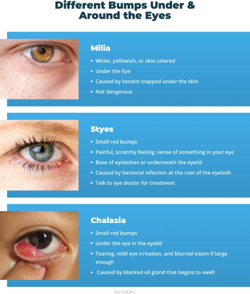 Bumps Under the Eyes: Types & How to Treat Them | NVISION Eye Centers