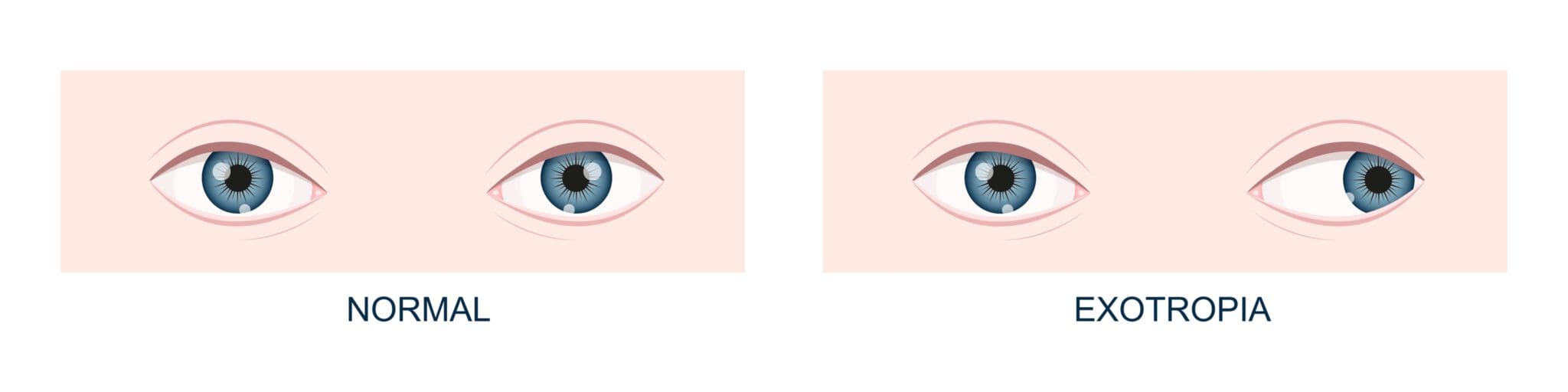 Exotropia (Eye Misalignment): Causes, Types and Treatment