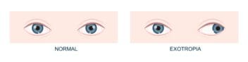 Exotropia (Eye Misalignment): Causes, Types and Treatment