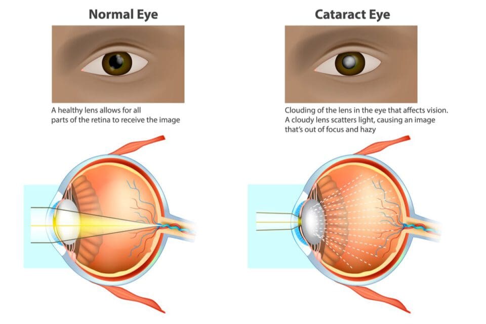 Eye Diseases: Resources on Conditions and Treatments
