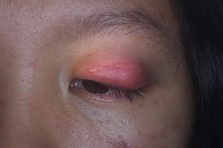 Cellulitis of the Eye (Orbital Cellulitis) – NVISION