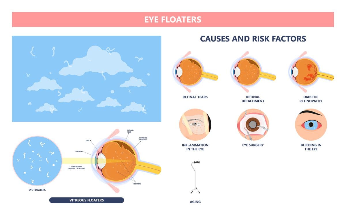 Eye Floaters Causes How To Get Rid Of Them For Good NVISION