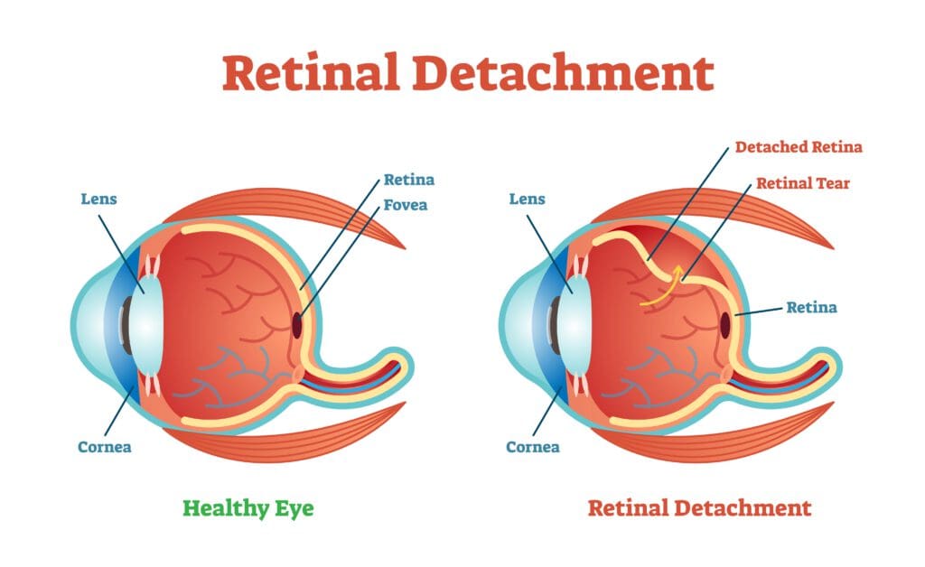 Retina Issues: What are the Symptoms?