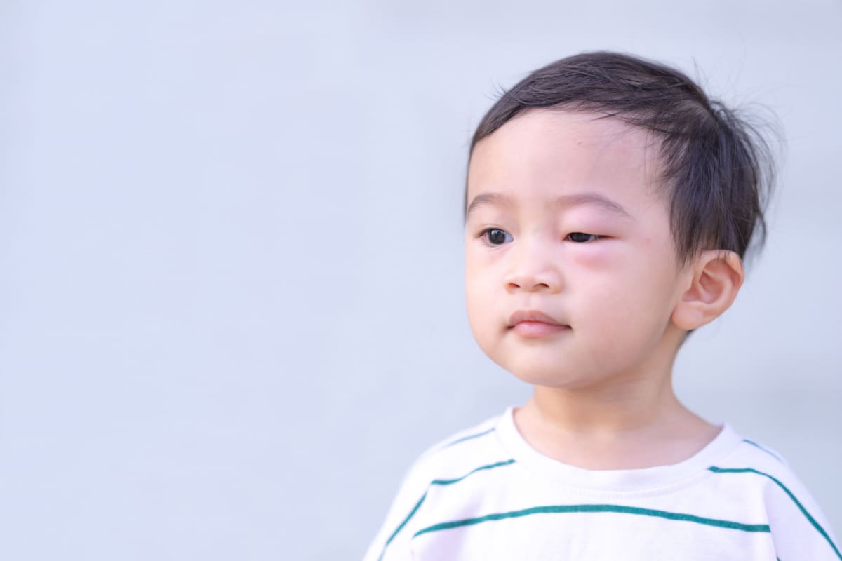 How To Treat Swollen Eyes In Toddlers NVISION Eye Centers