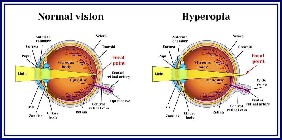 Nearsighted Vs Farsighted Which Is More Common Charolette Malley