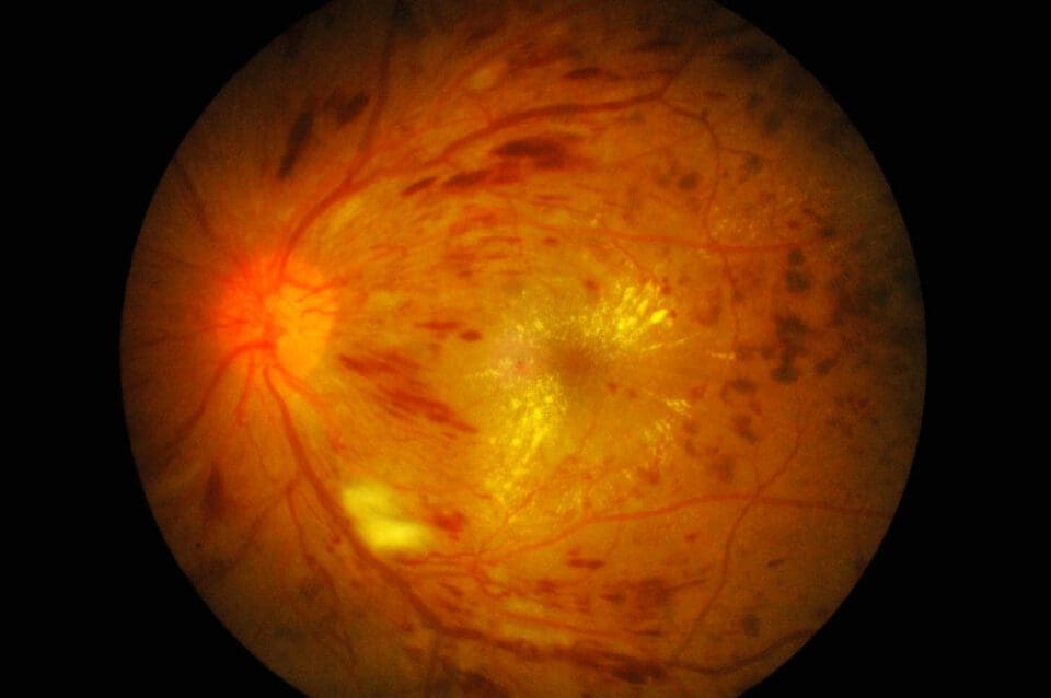 Retina Raleigh, Diabetic Retinopathy Raleigh