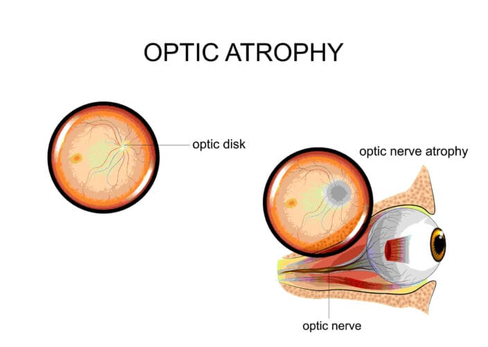 What Are The Signs Of Optic Atrophy How Do You Reverse It NVISION 