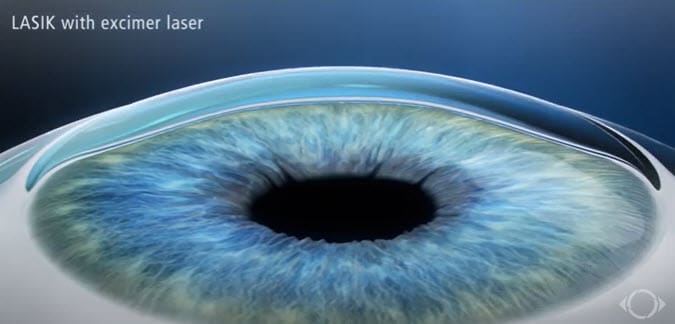 Lasik Eye Surgery 