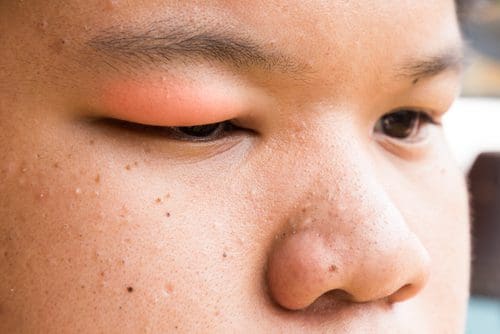 Puffy Eyes: 5 Quick Steps For Getting Rid Of The Problem