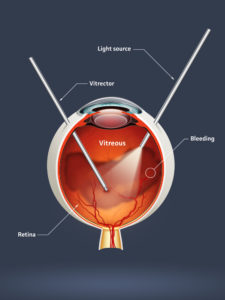 Do 'Natural' Treatments for Eye Floaters Work? | NVISION ...