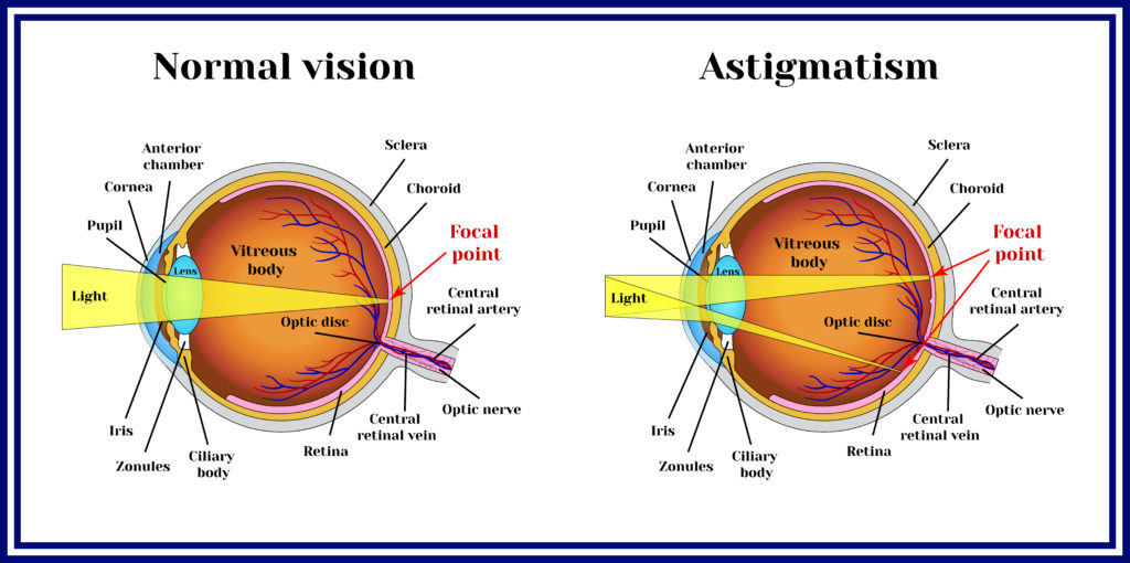 An Overview Of LASIK Surgery For Astigmatism NVISION Eye Centers