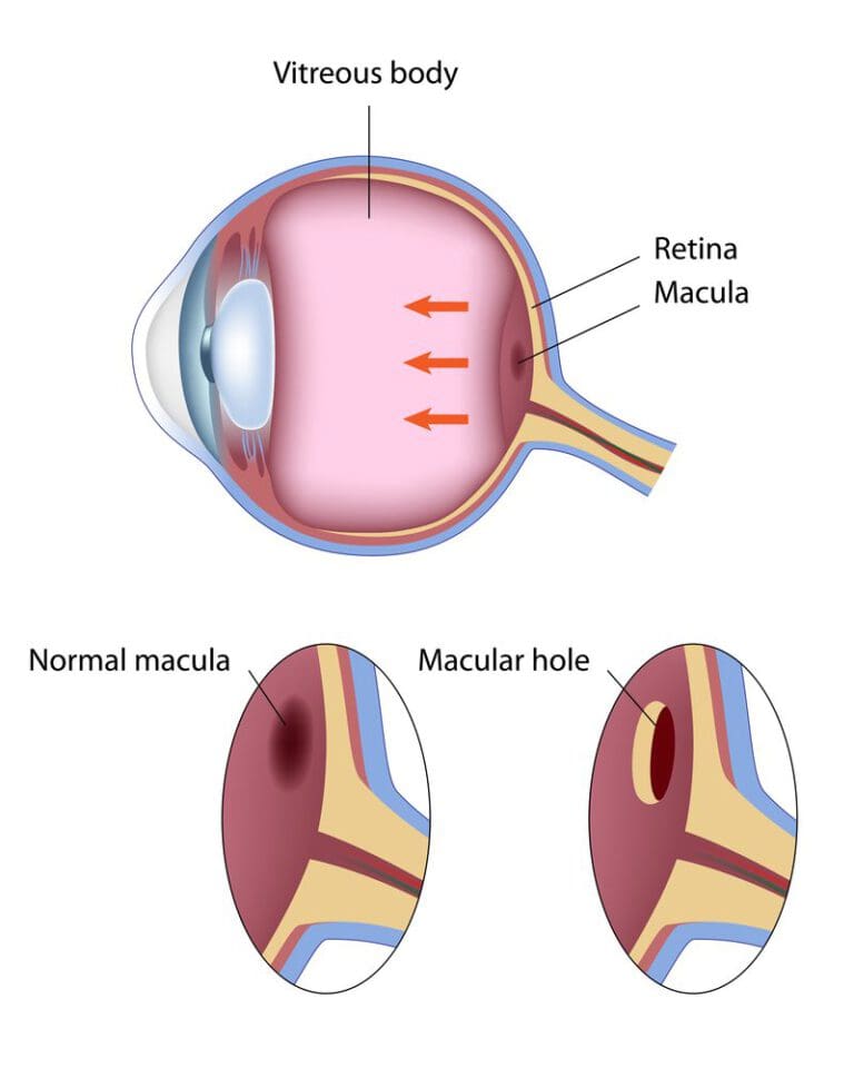 Pros & Cons Of Using Avastin To Treat Macular Degeneration | NVISION